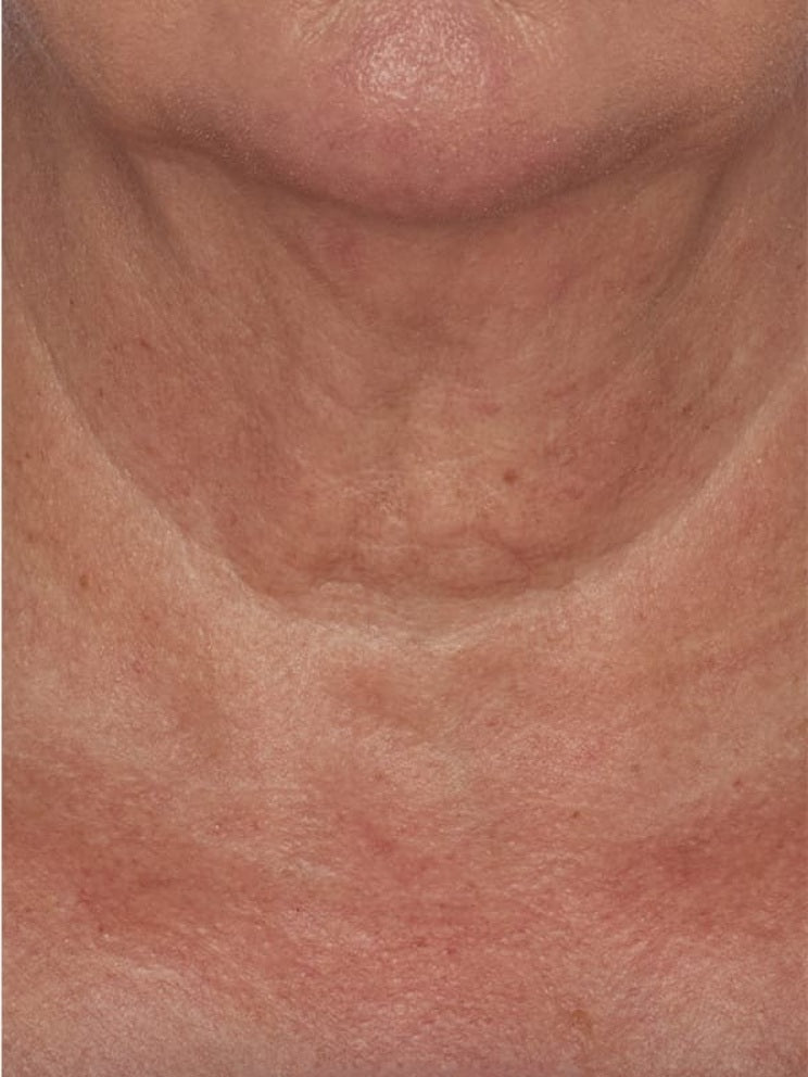 Cou et décolleté après utilisation de la crème
