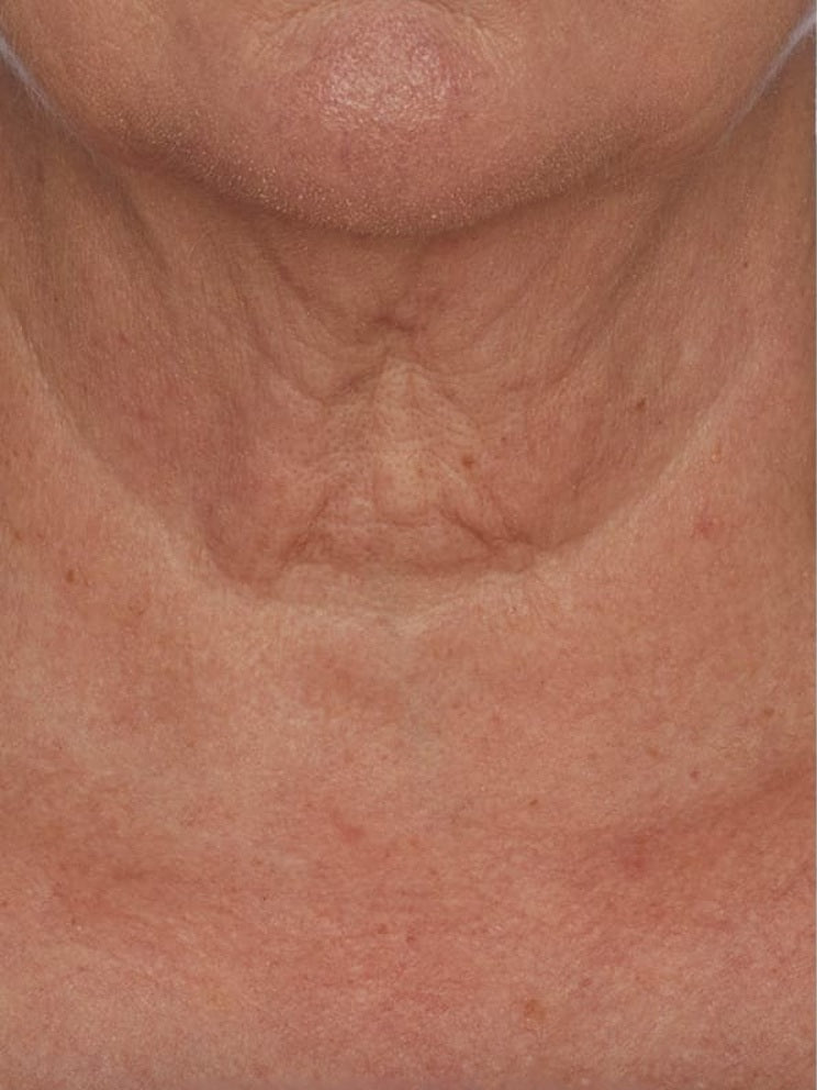 Cou et décolleté avant utilisation de la crème